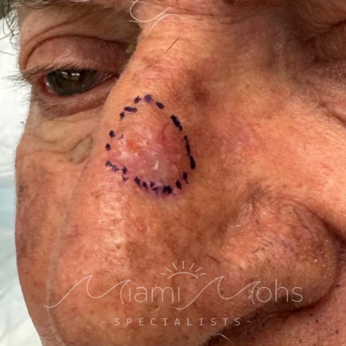 patient 1 01 before mohs