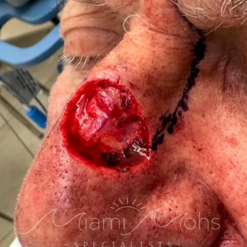 patient 1 02 post mohs