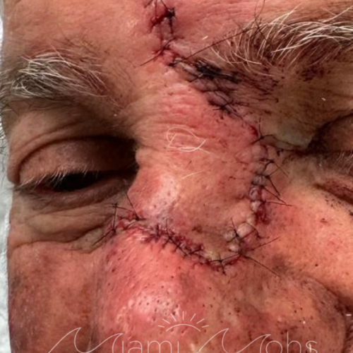 patient 1 03 post reconstruction