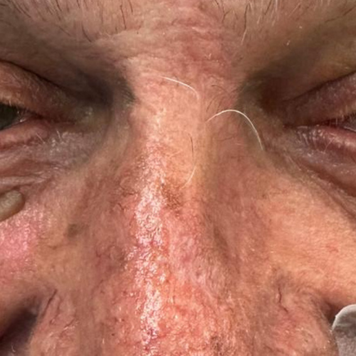 patient 1 05 3 month f u 2