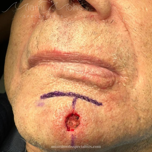 patient 2 02 post mohs