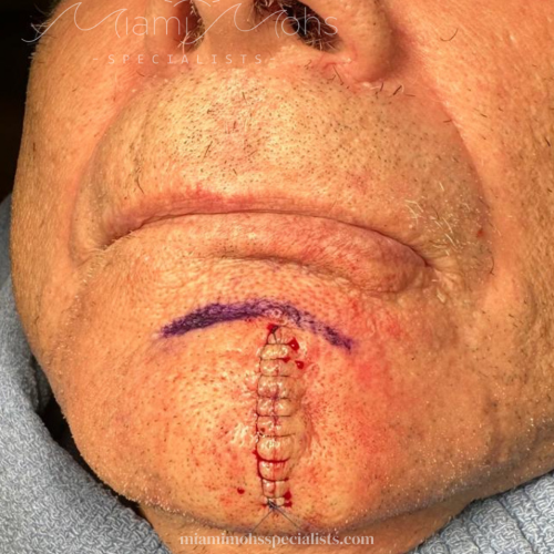 patient 2 03 post reconstruction 2