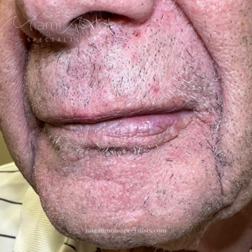 patient 2 04 10 month f u