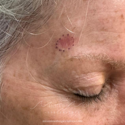 patient 3 01 before mohs (2)