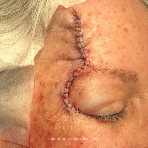 patient 3 03 post reconstruction