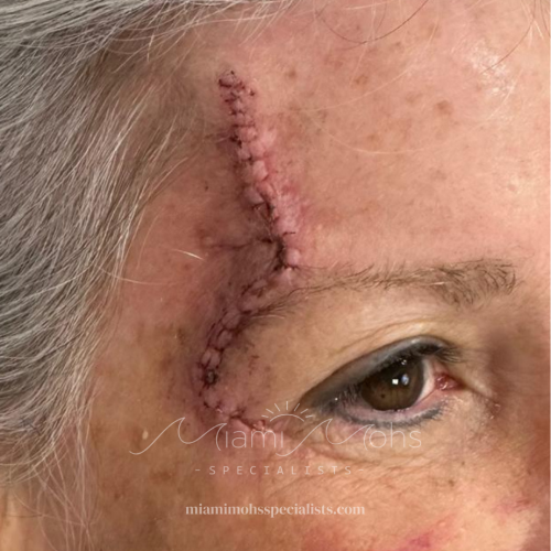 patient 3 04 1 week follow up