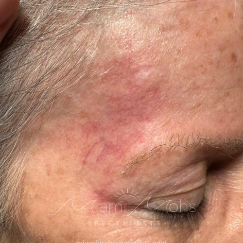 patient 3 2 month follow up